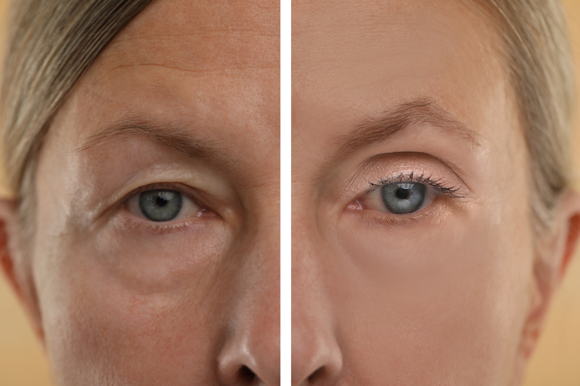 Blefaroplastika: majhen poseg za velik učinek.